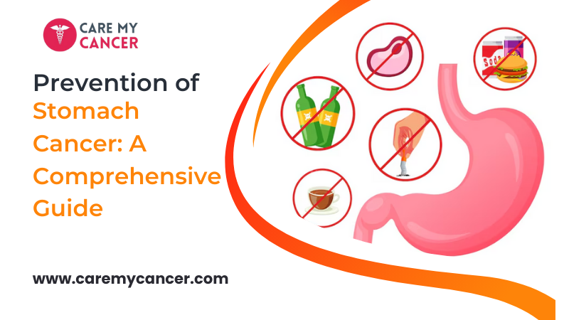 Prevention of Stomach Cancer: A Comprehensive Guide
